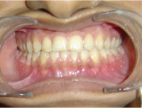 After Correction of forward jaw in adults