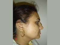 Image of Patient Before Correction of forward jaw in adults
