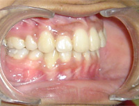 Correction of forward teeth