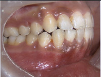 Correction of retruded jaw with crowding