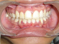 Position of Teeths After the Treatment