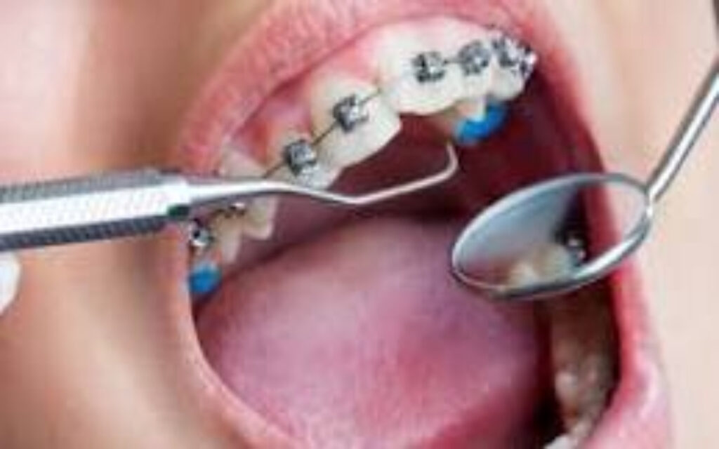 Best Orthodontic Treatment