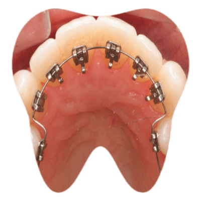 lingual braces technology