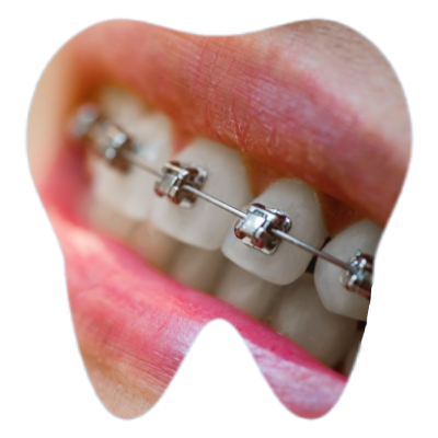 Self ligating braces