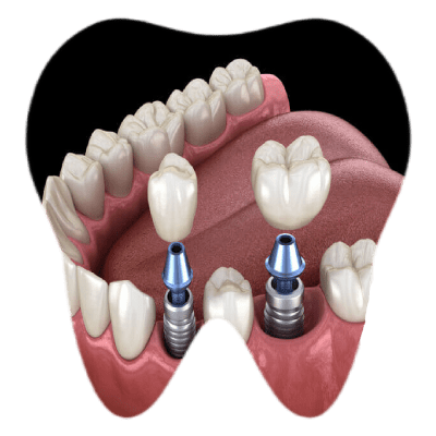 Best Orthodontic Implants in pune