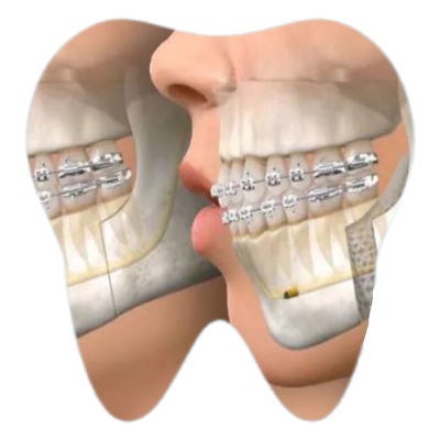 Orthognathic Surgery in Pune