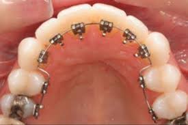Lingual Braces