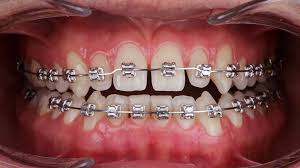 Metal Braces
