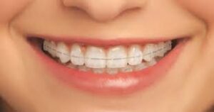 Clear Braces